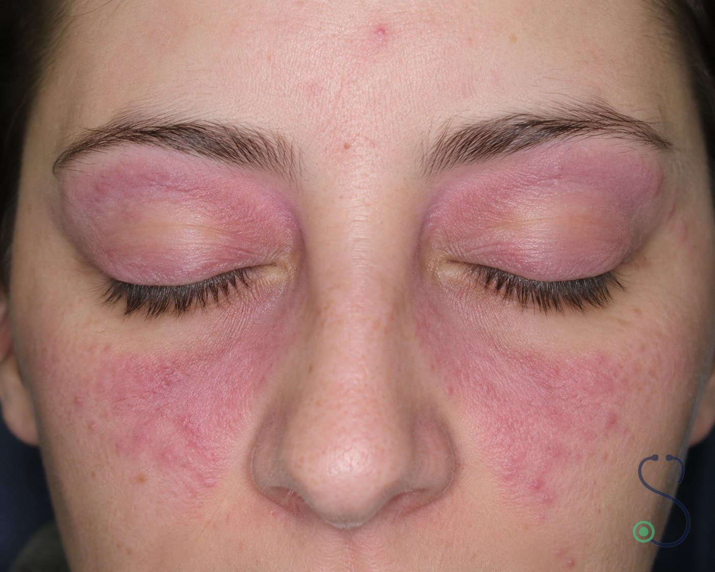 Violaceous discolouration of the upper eyelids with periorbital oedema